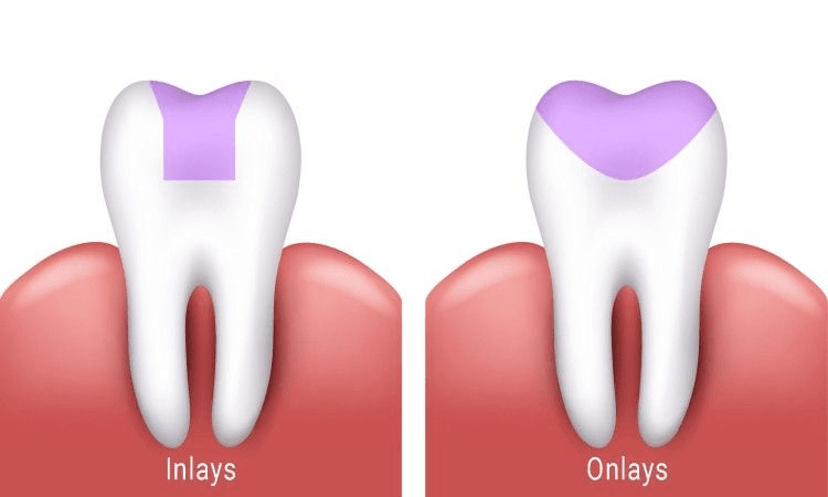 Professional teeth cleaning at Lebanon Dental Studio