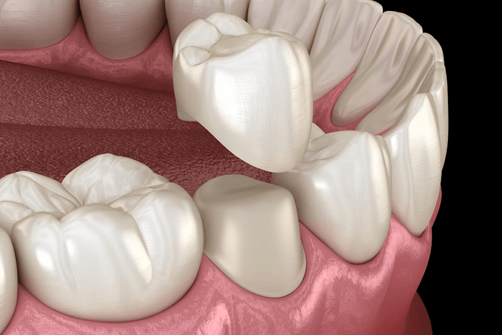 Custom dental prosthetics crowns and bridges Lebanon