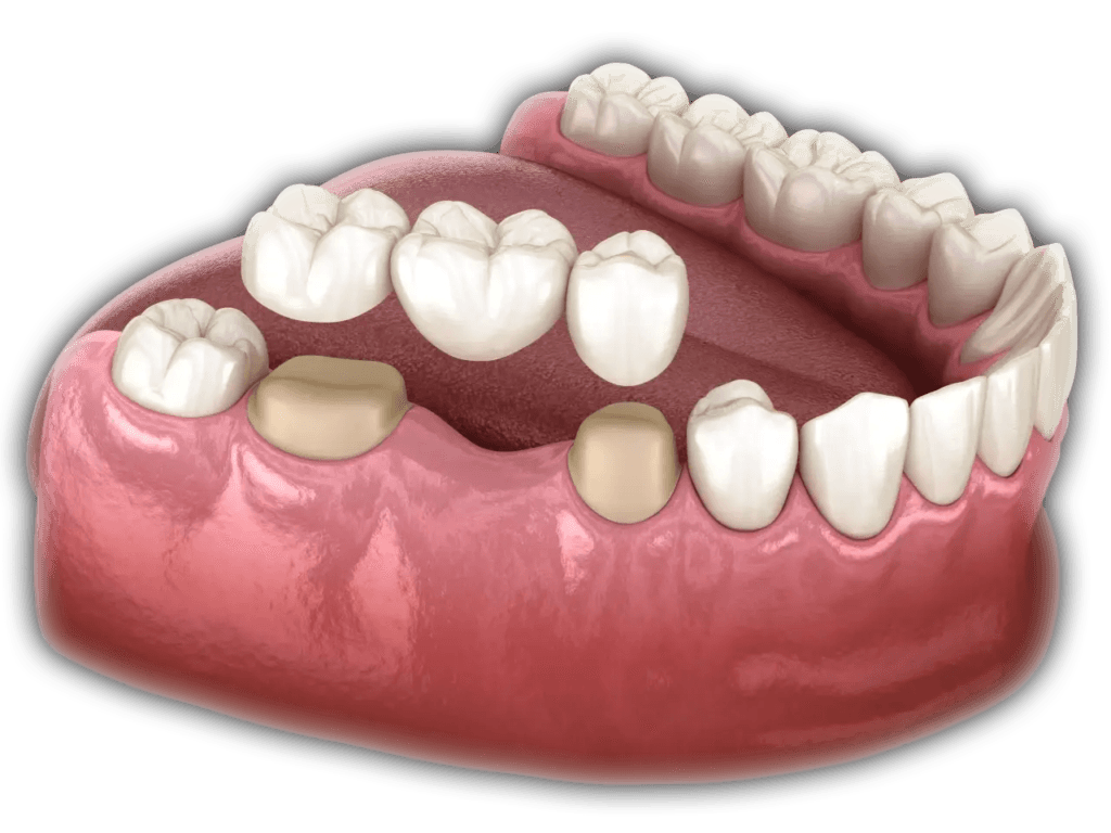 Orthodontic braces treatment in Jal el Dib Beyrouth