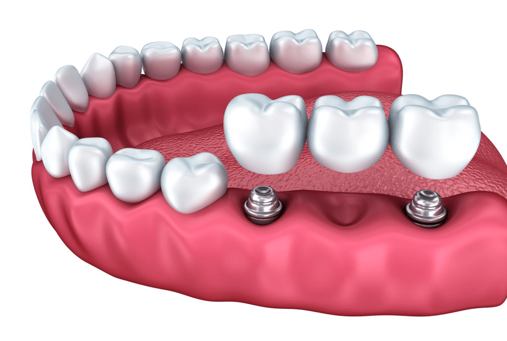 Clear aligners orthodontic treatment for adults Beyrouth