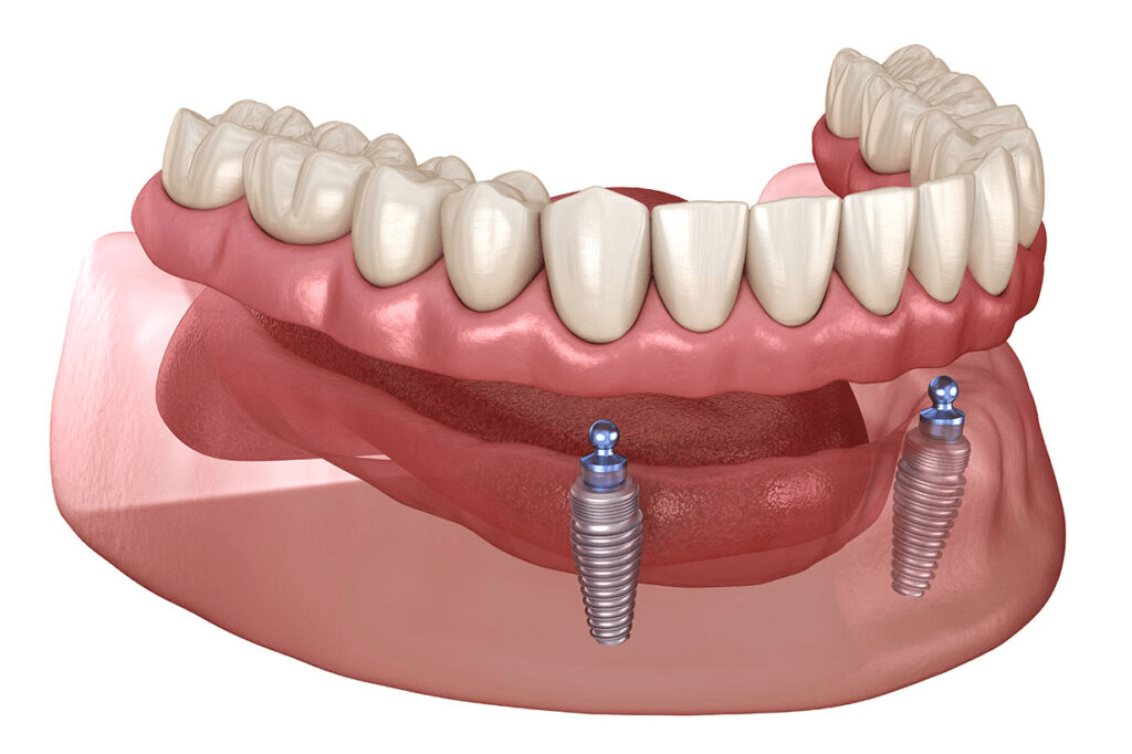 Bone grafting for dental implants at Lebanon Dental Studio