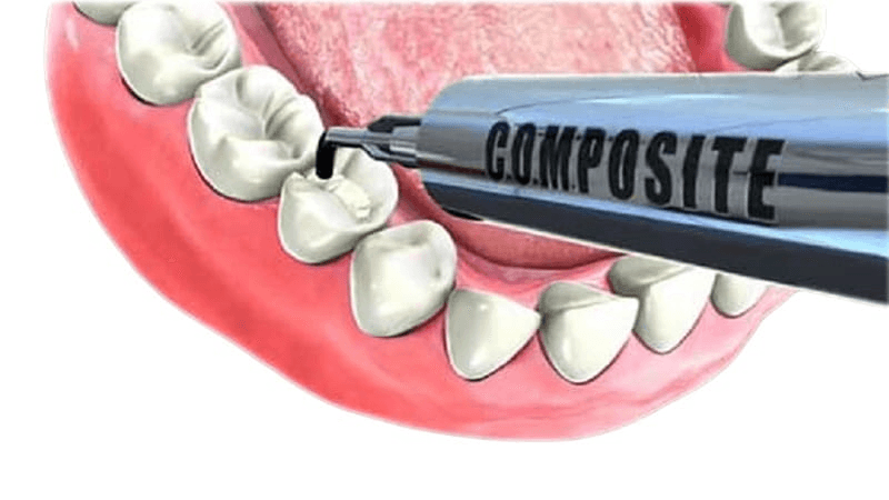 Restorative dental filling procedure in Jal el Dib