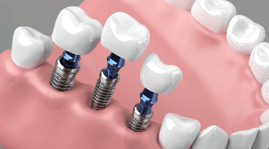Dental implant surgery procedure à Beyrouth Lebanon