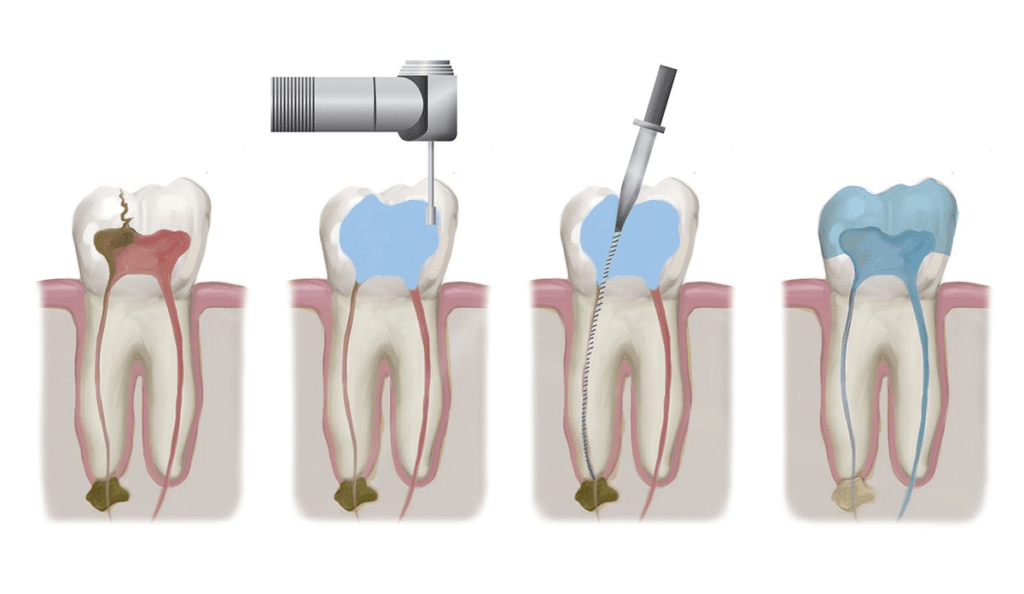 Root canal endodontic treatment in Jal el Dib Beyrouth