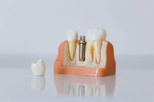 Clinical close-up of a dental implant model used in Lebanon implant pricing guides