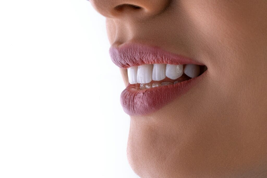 Close-up of a radiant Hollywood smile after E.max veneer treatment in Lebanon