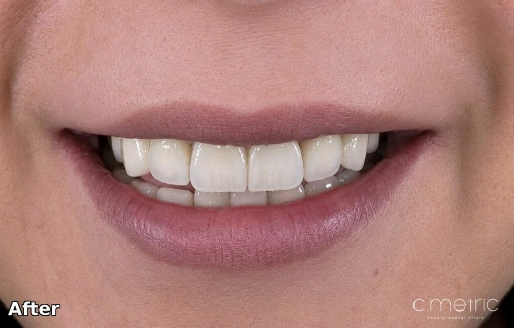 After: anterior crowns from canine to canine by Dr. Rita Kanbar, Lebanon Dental Studio