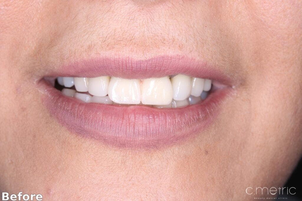 Before: worn, uneven front teeth, anterior crowns case by Dr. Rita Kanbar