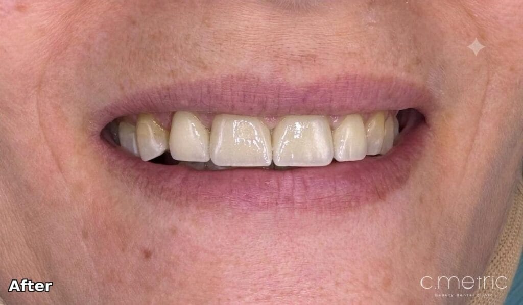 After: zirconia crowns closing the gap, natural smile. Dr. Rita Kanbar