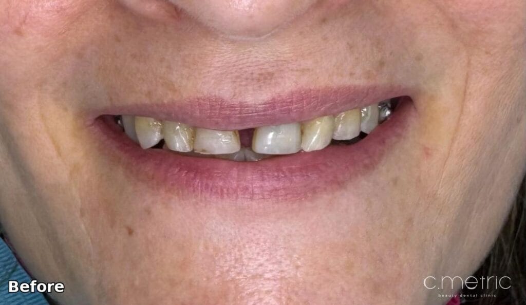 Before: midline gap and missing canine, case by Dr. Rita Kanbar