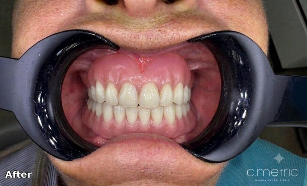 After: complete denture full-arch rehabilitation. Dr. Rita Kanbar