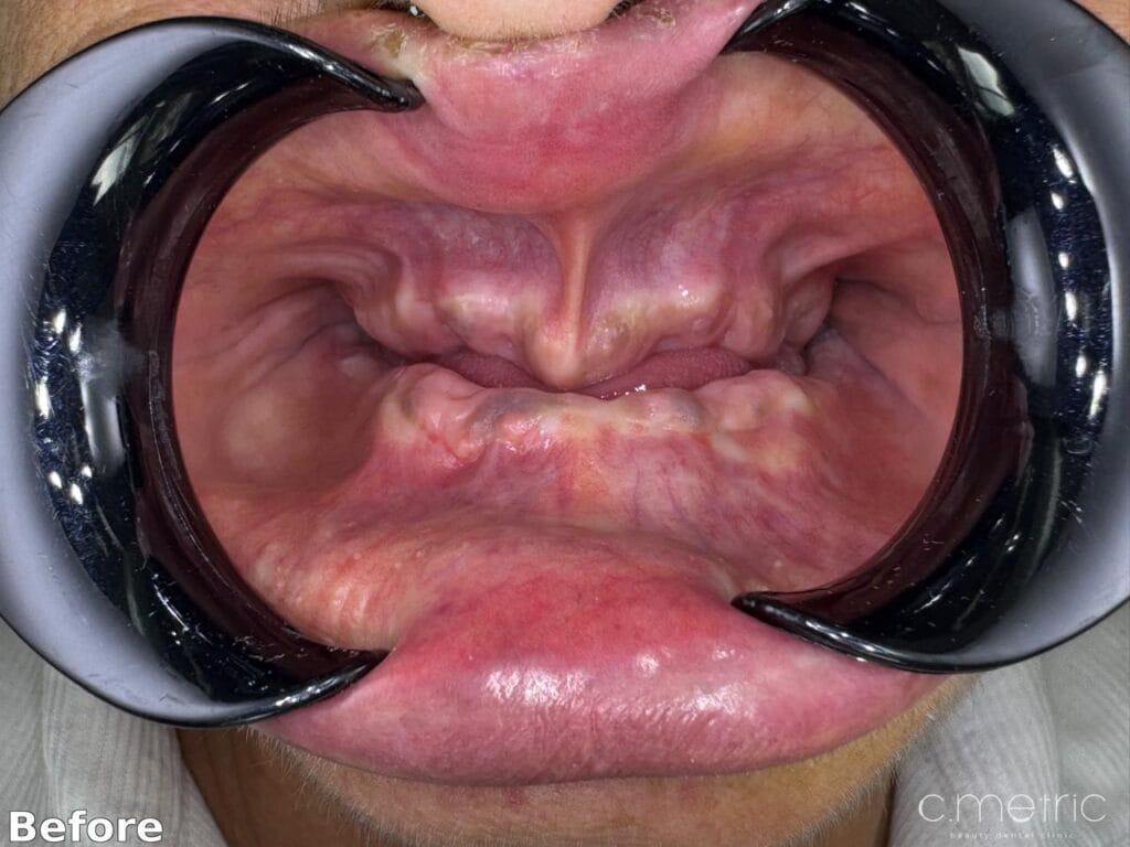 Before: missing teeth across both arches, case by Dr. Rita Kanbar